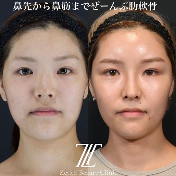 鉄医師による鼻のフルコースの施術前／施術後3ヶ月 After 