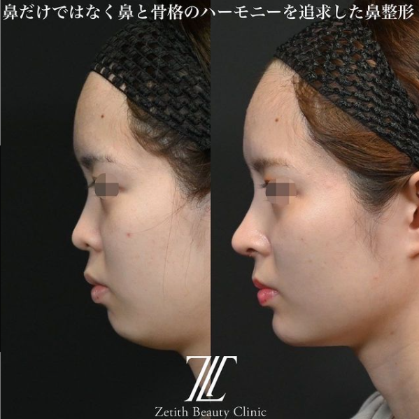 鉄医師による鼻のフルコースの施術前／施術後1ヶ月 施術後 