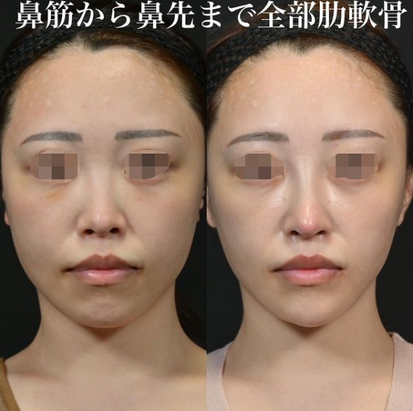 鉄医師による鼻のフルコースの施術前／施術後1ヶ月