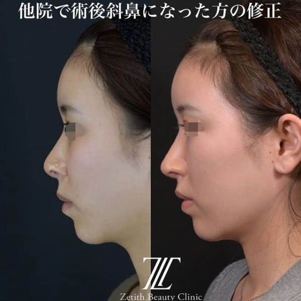 鉄医師による鼻のフルコースの施術前／施術後3ヶ月 After 