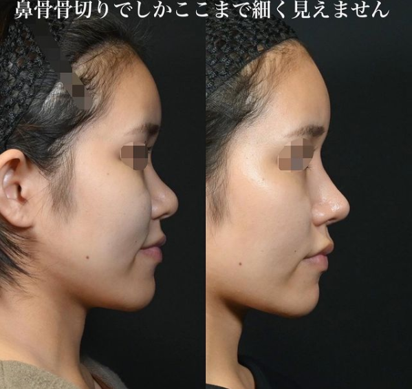 鉄医師による鼻のフルコースの施術前／施術後1ヶ月 Дараа 