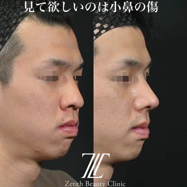 鉄医師による鼻のフルコースの施術前／施術後1ヶ月 施術後 