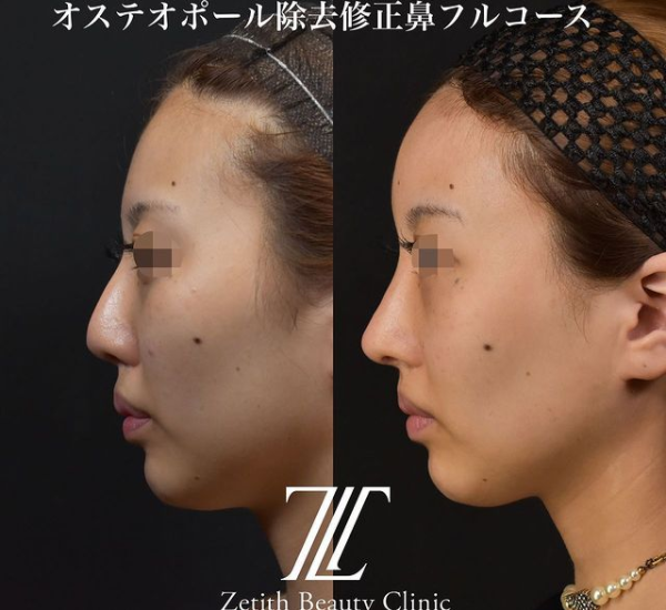鉄医師による鼻のフルコースの施術前／施術後1ヶ月 施術後 