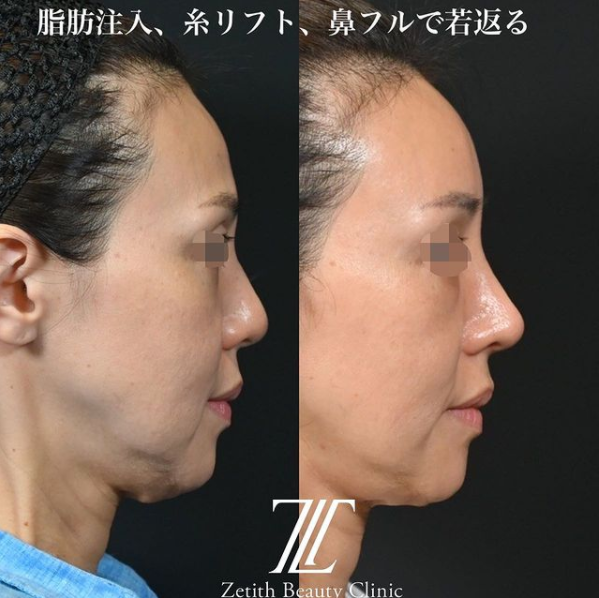 鉄医師による鼻のフルコースの施術前／施術後1ヶ月
