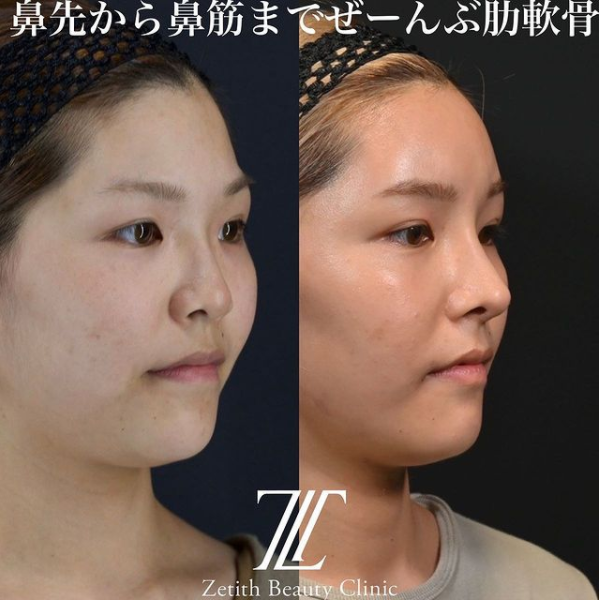 鉄医師による鼻のフルコースの施術前／施術後3ヶ月