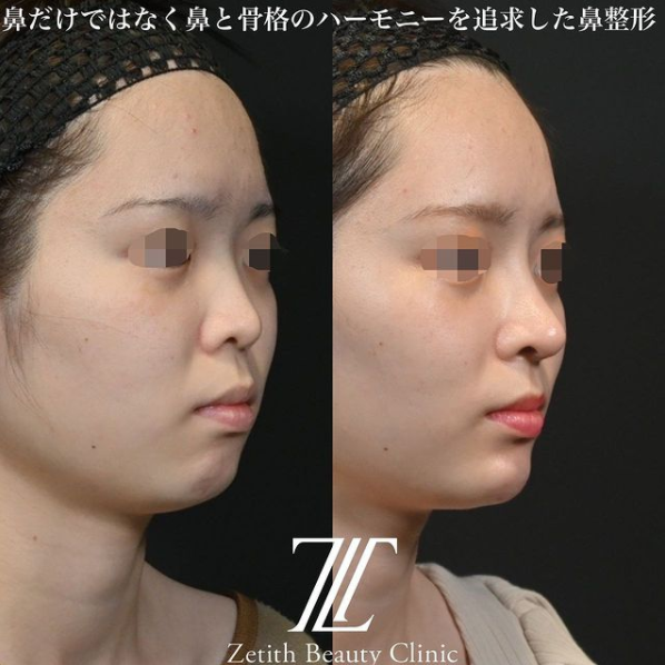 鉄医師による鼻のフルコースの施術前／施術後1ヶ月