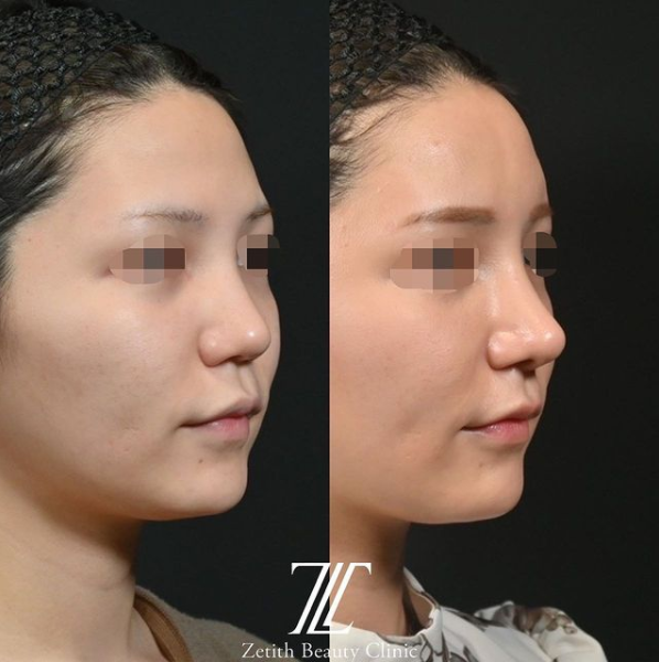 鉄医師による鼻のフルコースの施術前／施術後1ヶ月