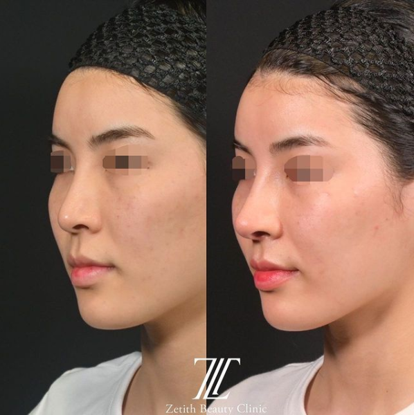 鉄医師による鼻のフルコースの施術前／施術後1ヶ月