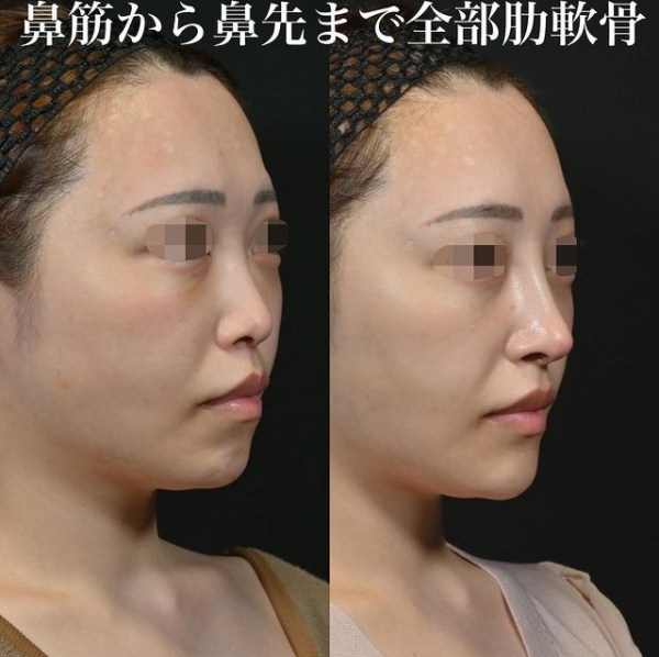鉄医師による鼻のフルコースの施術前／施術後1ヶ月 术后 