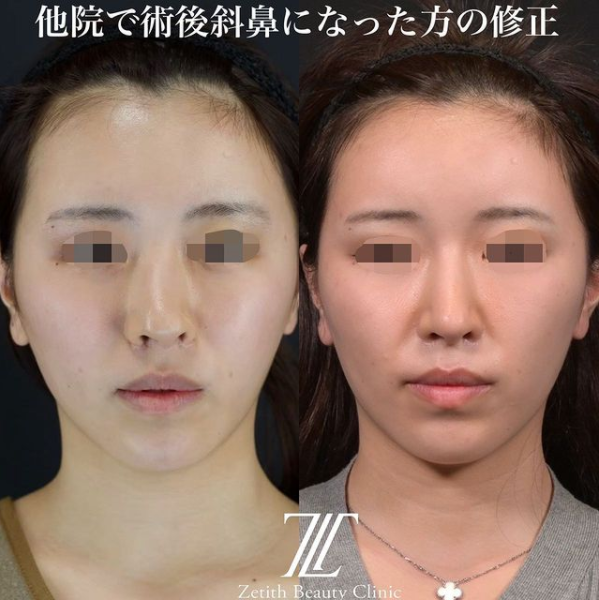 鉄医師による鼻のフルコースの施術前／施術後3ヶ月