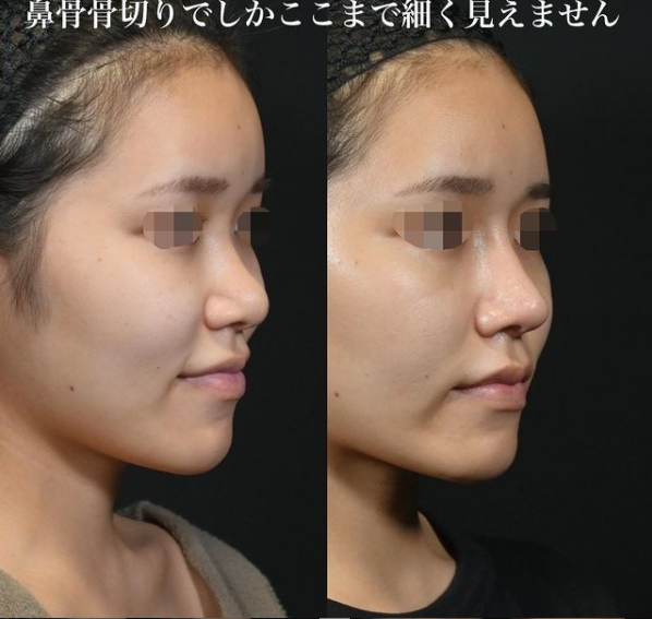 鉄医師による鼻のフルコースの施術前／施術後1ヶ月