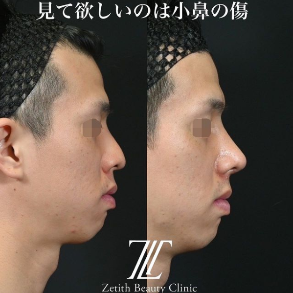 鉄医師による鼻のフルコースの施術前／施術後1ヶ月