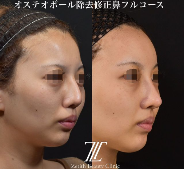 鉄医師による鼻のフルコースの施術前／施術後1ヶ月