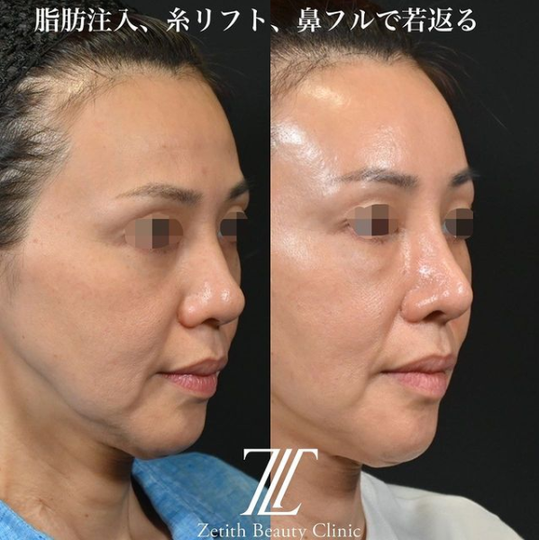 鉄医師による鼻のフルコースの施術前／施術後1ヶ月 施術後 