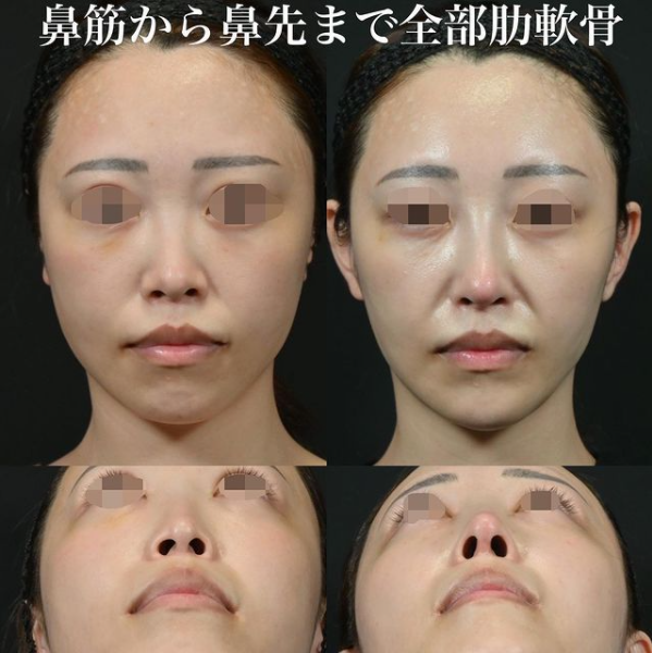 鉄医師による鼻のフルコースの施術前／施術後3ヶ月 Дараа 
