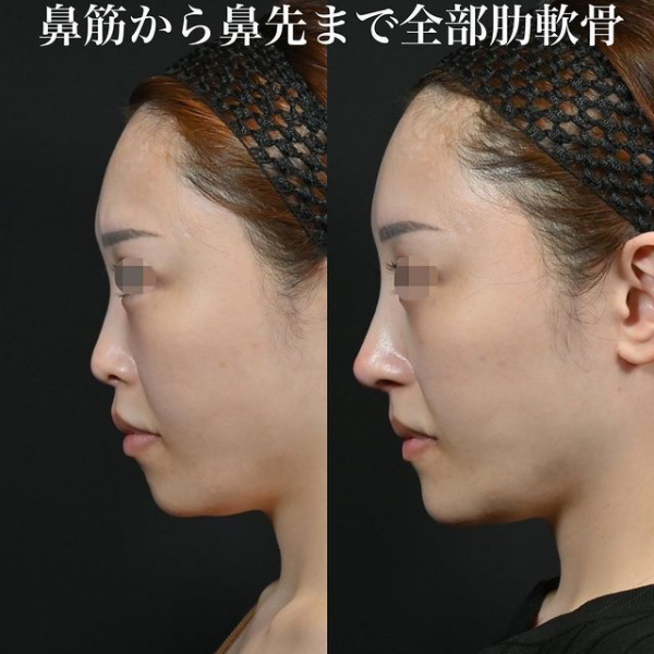 鉄医師による鼻のフルコースの施術前／施術後3ヶ月