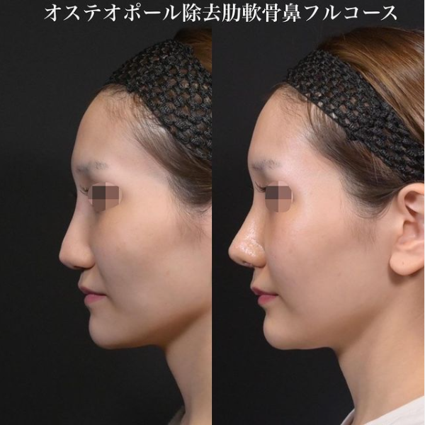鉄医師による鼻のフルコースの施術前／施術後1ヶ月
