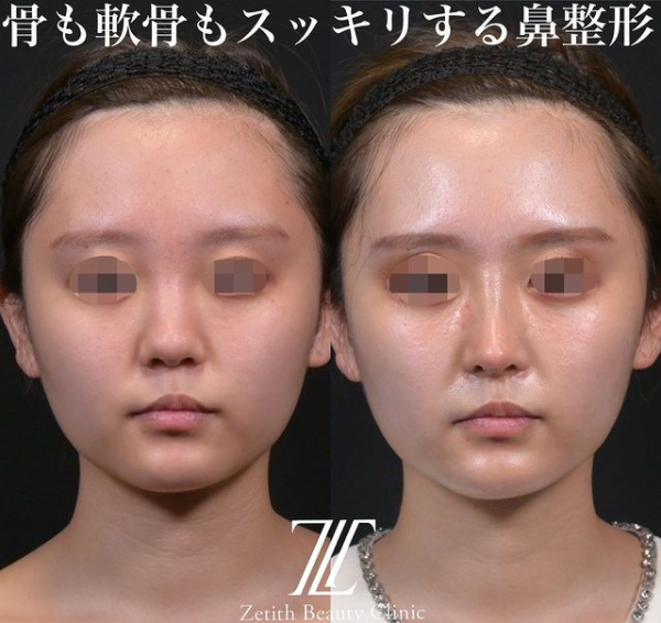 鉄医師による鼻のフルコースの施術前／施術後2週間