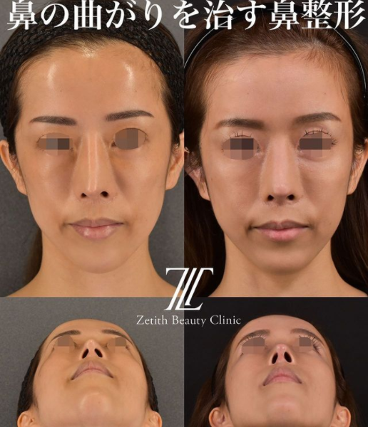 鉄医師による鼻のフルコースの施術前／施術後3ヶ月 施術後 