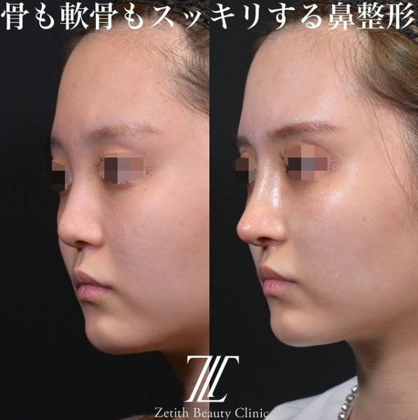 鉄医師による鼻のフルコースの施術前／施術後2週間 施術後 
