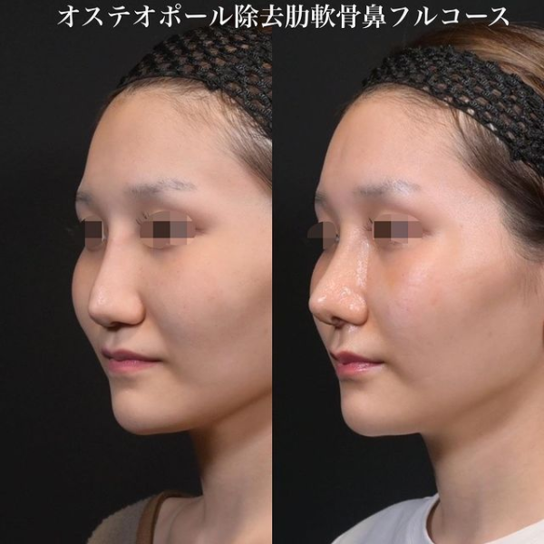 鉄医師による鼻のフルコースの施術前／施術後1ヶ月 بعد 