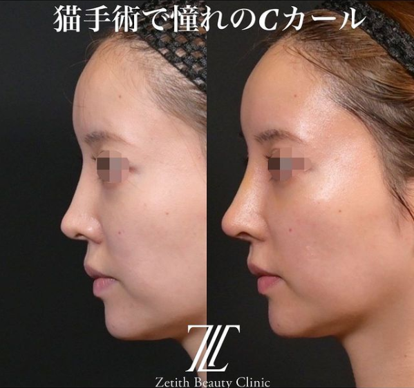 鉄医師による鼻のフルコースの施術前／施術後1週間