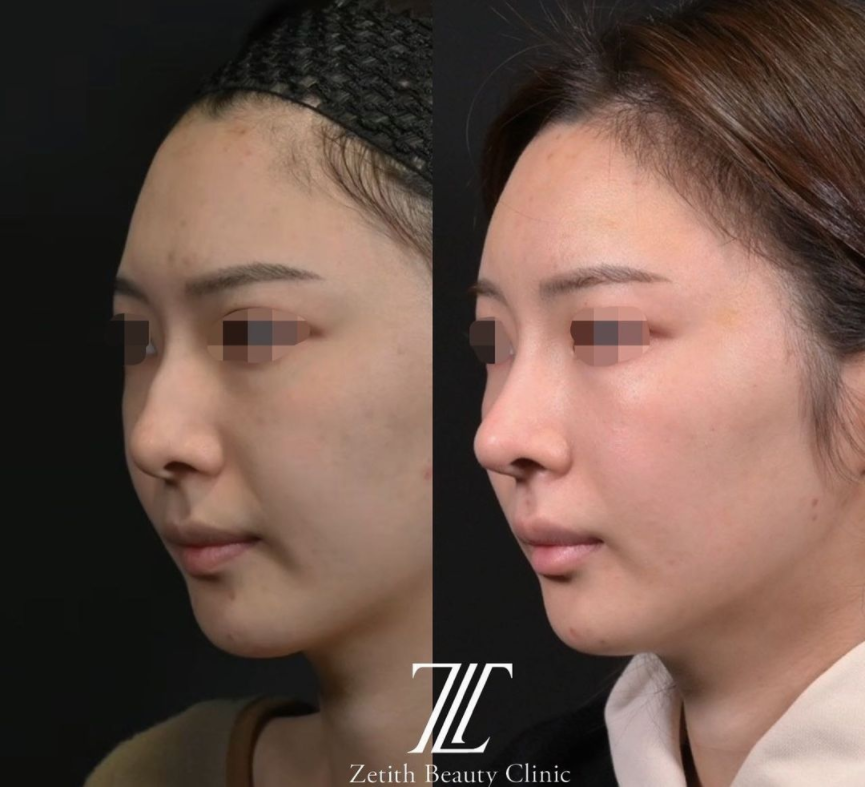 鉄医師による鼻のフルコースの施術前／施術後3ヶ月