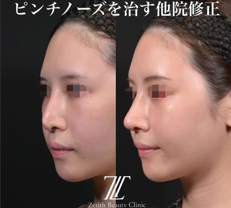 鉄医師による鼻の施術前／施術後1ヶ月 หลัง 