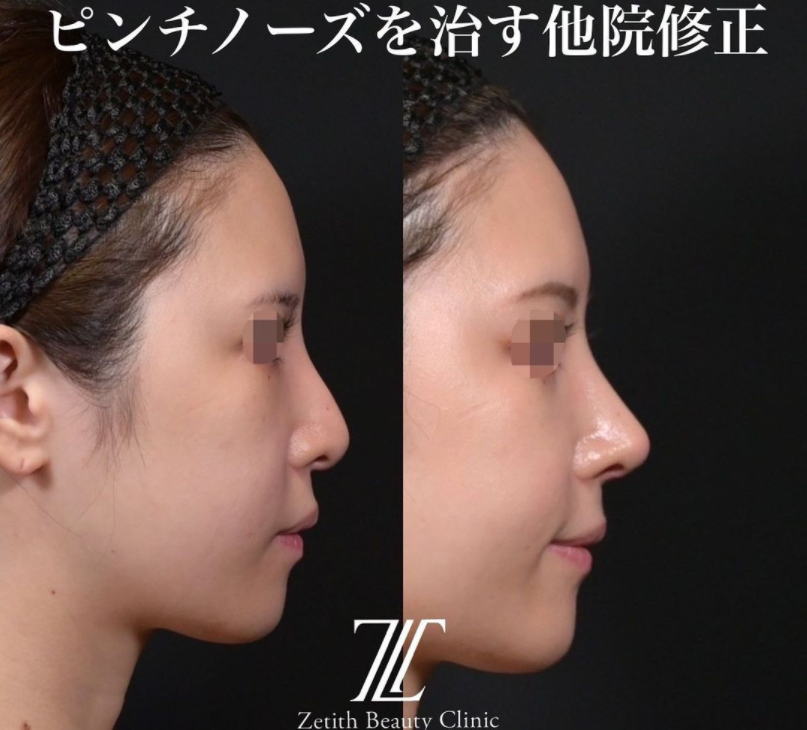 鉄医師による鼻の施術前／施術後1ヶ月