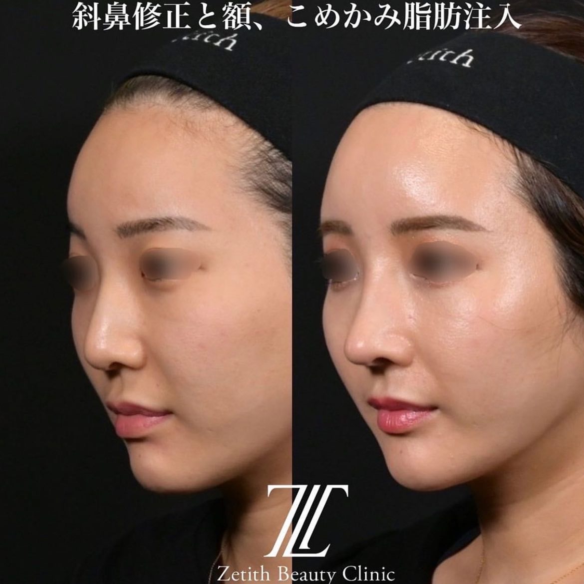 鉄医師による鼻整形の施術前／施術後１ヶ月 术后 