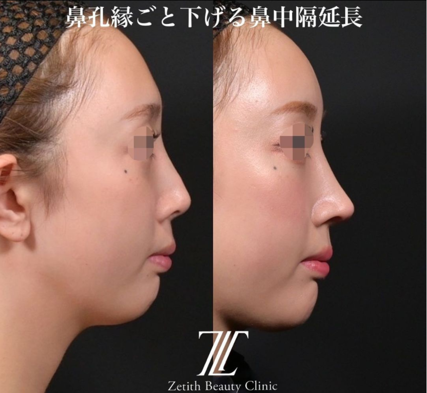 鉄医師による鼻のフルコースの施術前／施術後1ヶ月 施術後 