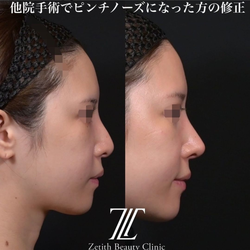 鉄医師による鼻のフルコースの施術前／施術後3ヶ月 施術後 