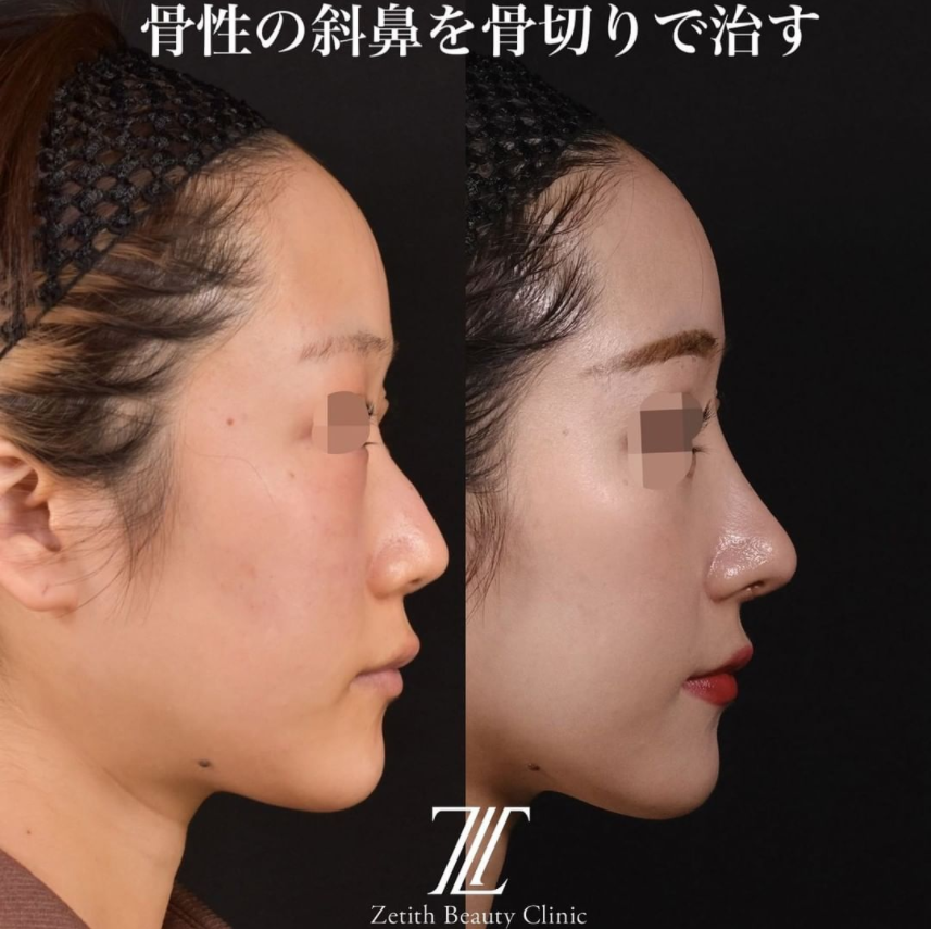 鉄医師による鼻のフルコースの施術前／施術後1ヶ月 施術後 