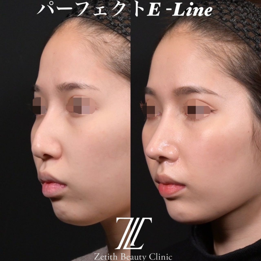鉄医師による鼻のフルコースの施術前／施術後1ヶ月 施術後 