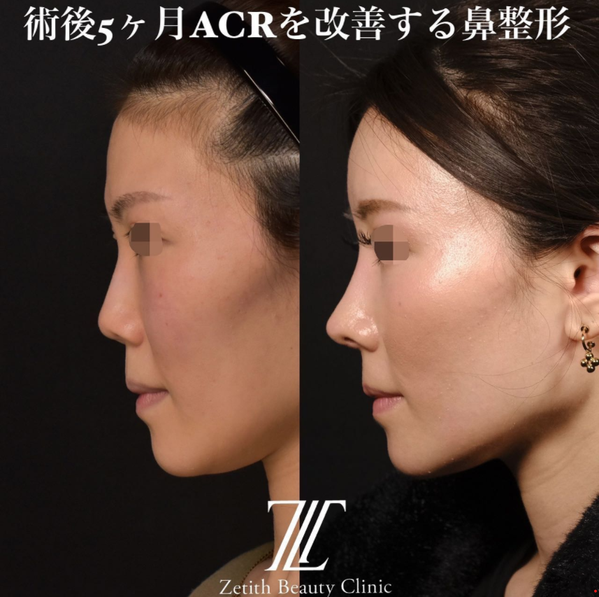 鉄医師による鼻のフルコースの施術前／施術後5ヶ月 หลัง 