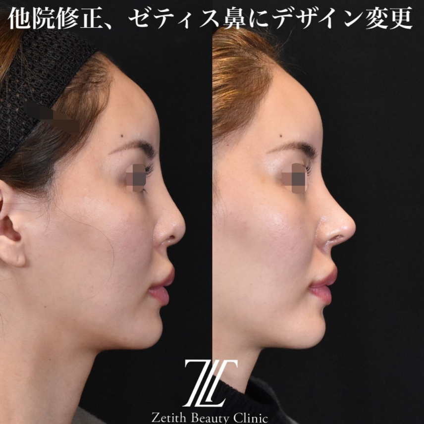 鉄医師による鼻のフルコースの施術前／施術後1ヶ月 หลัง 