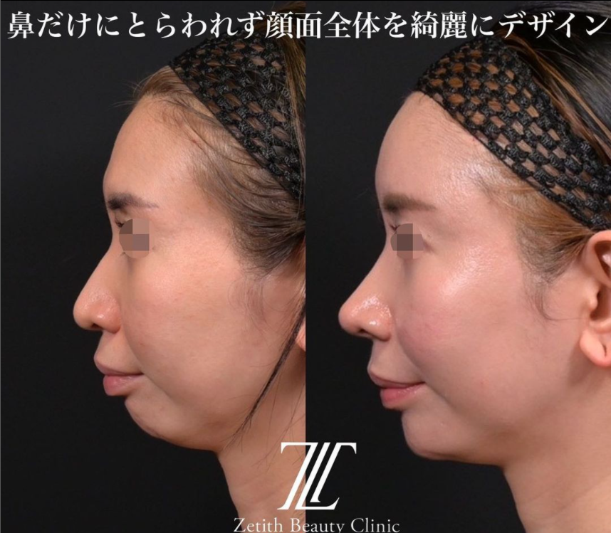 鉄医師による鼻のフルコースの施術前／施術後3ヶ月 术后 