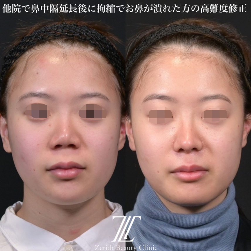 鉄医師による鼻のフルコースの施術前／施術後1ヶ月