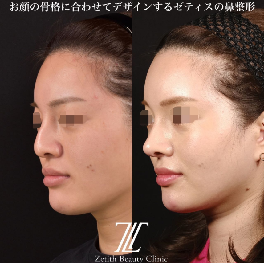 鉄医師による鼻のフルコースの施術前／施術後3ヶ月 施術後 
