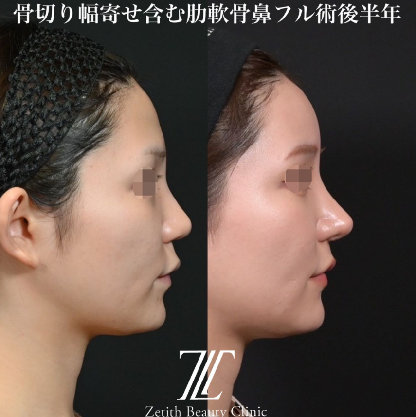 鉄医師による鼻のフルコースの施術前／施術後6ヶ月