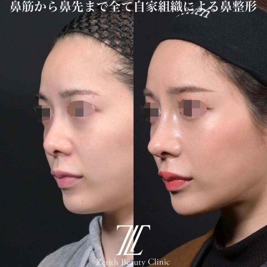 鉄医師による鼻のフルコースの施術前／施術後1ヶ月