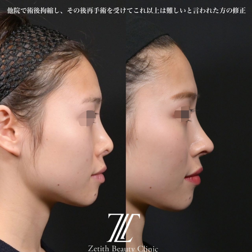 鉄医師による鼻のフルコースの施術前／施術後1ヶ月 施術後 