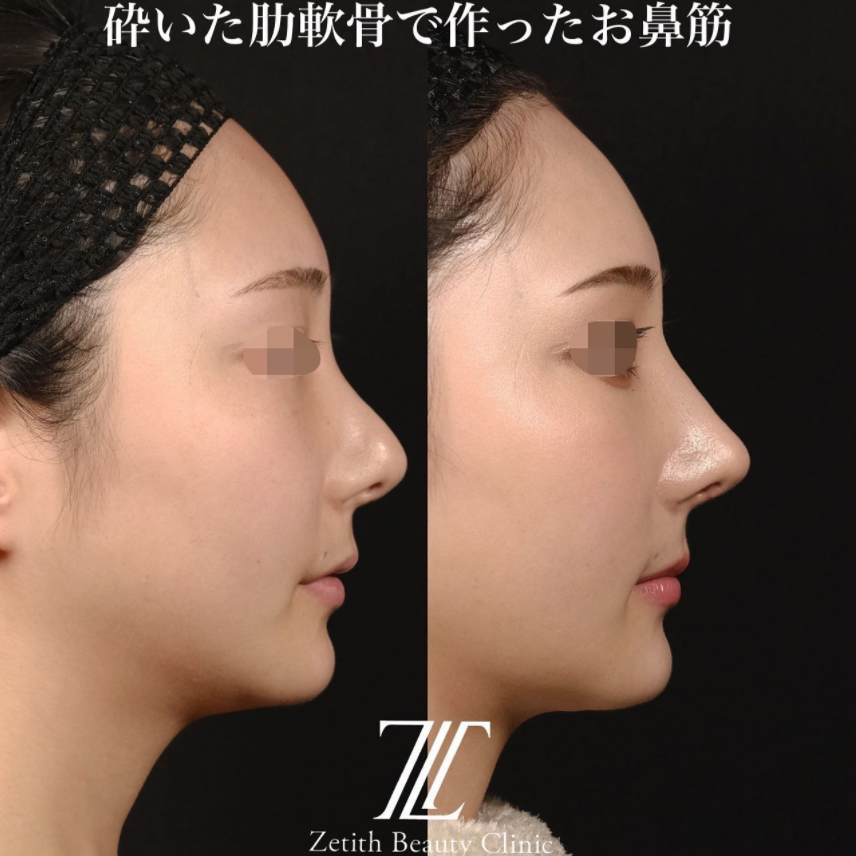 鉄医師による鼻のフルコースの施術前／施術後1ヶ月 施術後 