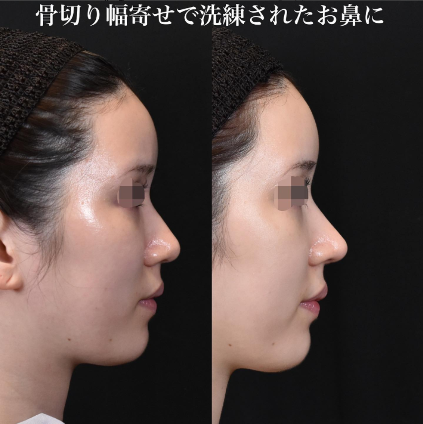 鉄医師による鼻のフルコースの施術前／施術後1ヶ月 施術後 