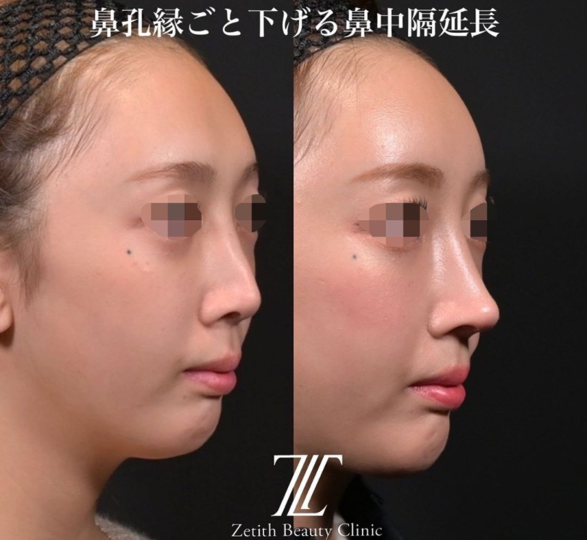 鉄医師による鼻のフルコースの施術前／施術後1ヶ月