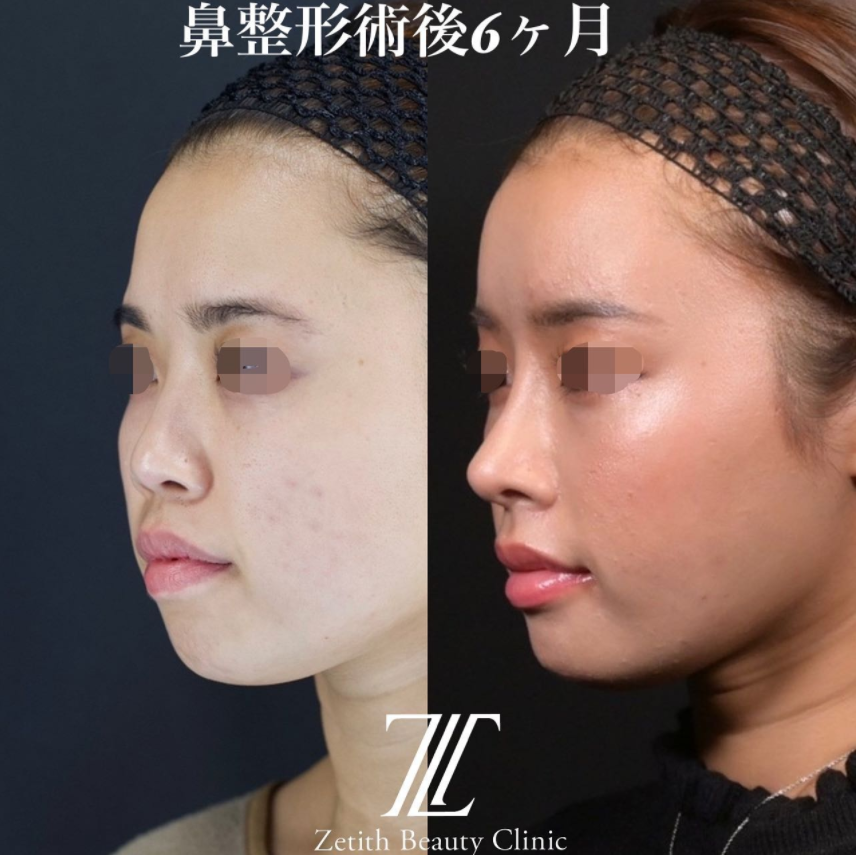 鉄医師による鼻のフルコースの施術前／施術後6ヶ月