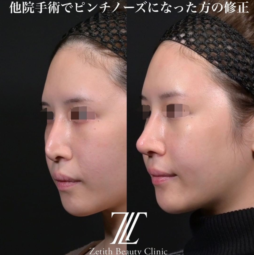 鉄医師による鼻のフルコースの施術前／施術後3ヶ月