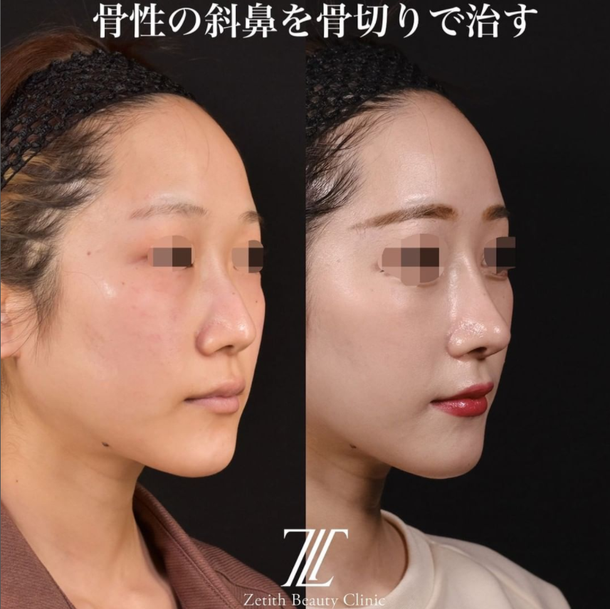 鉄医師による鼻のフルコースの施術前／施術後1ヶ月