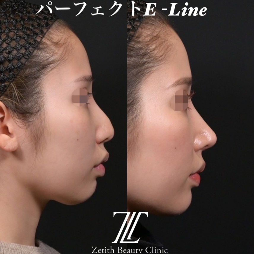 鉄医師による鼻のフルコースの施術前／施術後1ヶ月