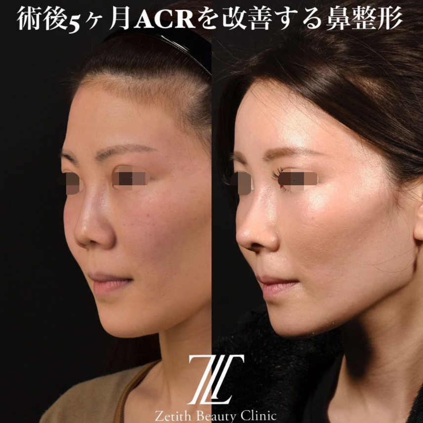 鉄医師による鼻のフルコースの施術前／施術後5ヶ月